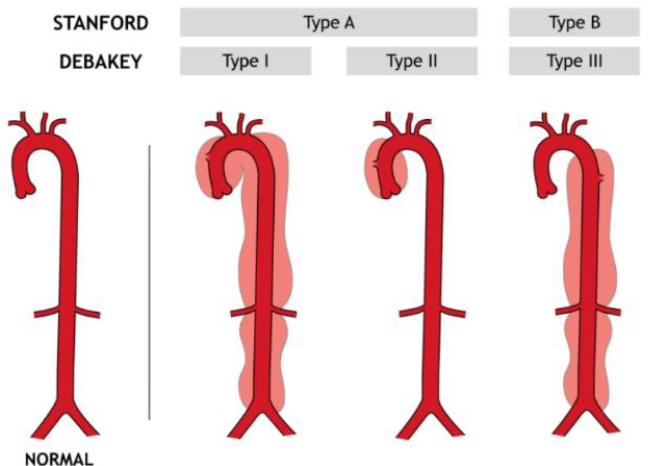 <ul><li><p>stanford A→ proximal aorta</p><ul><li><p>De Bakey t1- ascending, arch and descending aorta</p></li><li><p>De Bakey t2- only ascending aorta</p></li></ul></li><li><p>stanford B/ De Bakey t3- only dscending aorta</p></li></ul><p></p>
