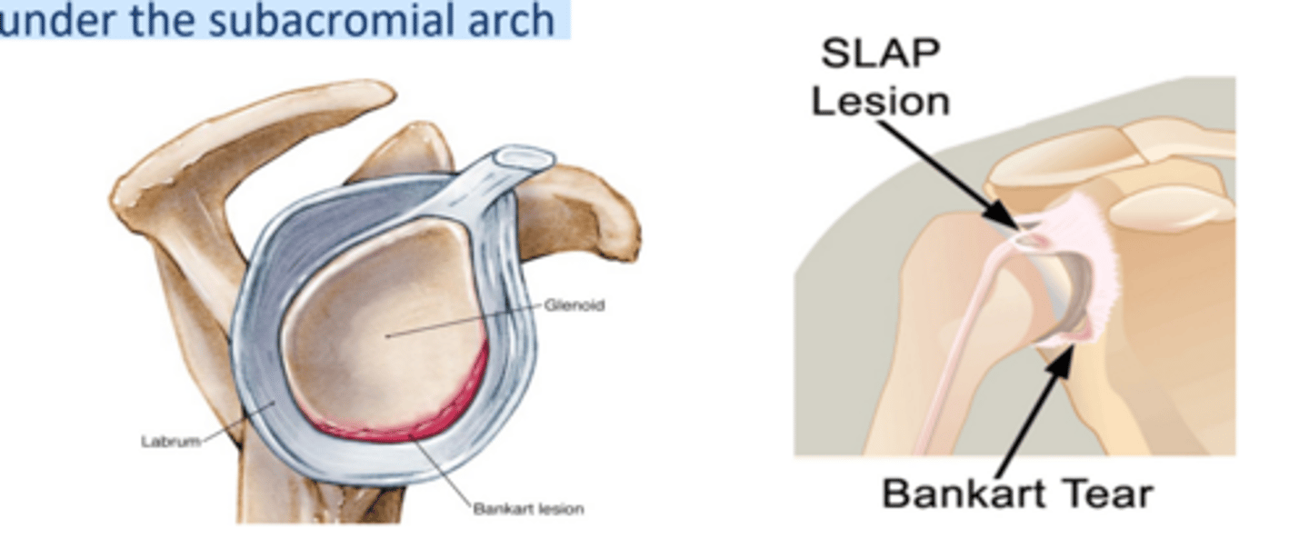 <p>A key site of pathology and an active treatment site</p><p>• Superior Labrum Anterior Posterior (SLAP) lesion is superior</p><p>labrum tearing or pulling away by the biceps insertion, which is</p><p>under the subacromial arch</p>