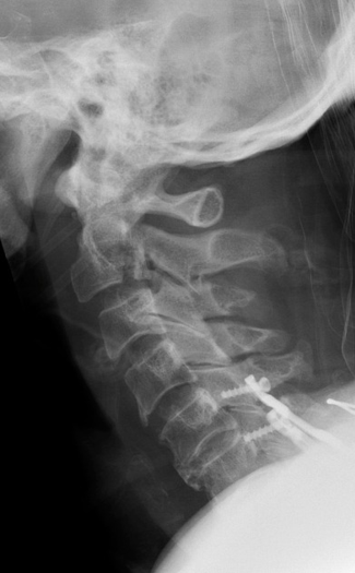 <p>hangman’s fx radiographic appearance </p>