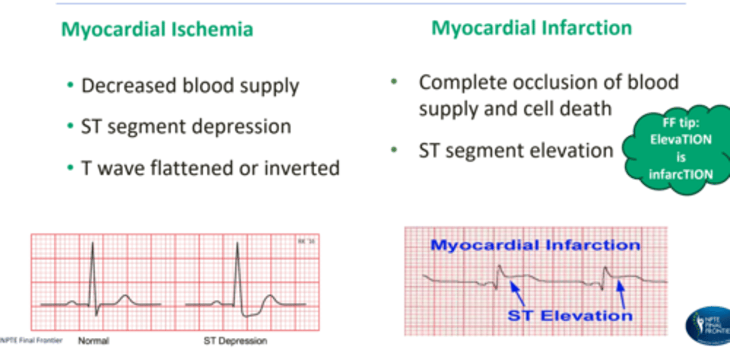 <p>elevaTION is infarcTION</p>