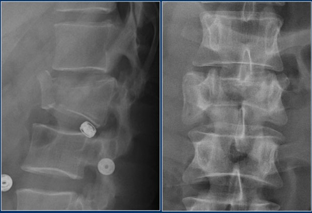 <p>What does the convex appearance of the back of the vertebral body indicate?</p><p>What does the increased interpedicular distance indicate?</p>