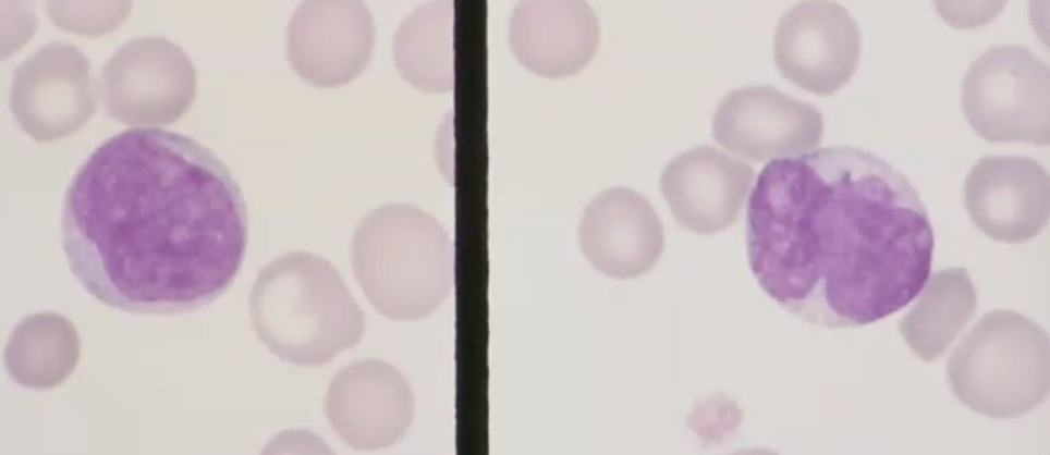 <p>myeloblast vs monoblast </p>