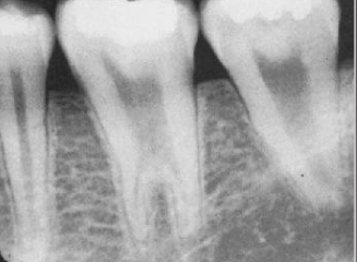 <p>enlargement of the body and pulp chamber, most common in mand molars/ premolars, no tx necessary</p>