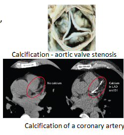 <p>Calcification is a <strong>buildup </strong>of <strong>calcium salts</strong> in <strong>tissues</strong>.</p><ul><li><p>It can occur in <strong>damaged</strong> <strong>tissues</strong> or <strong>normal</strong> <strong>tissues</strong> (<strong>hyperparathyroidism</strong>)</p></li></ul><p></p>