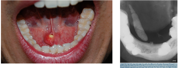 <p>salivary stones (sialolithiasis) clinical signs</p>