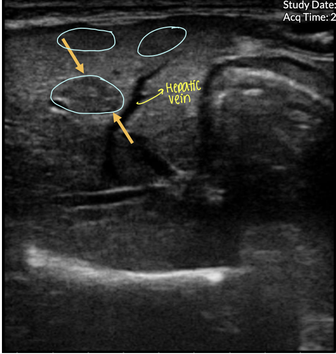 <p>what is occurring in the following ultrasound?</p>