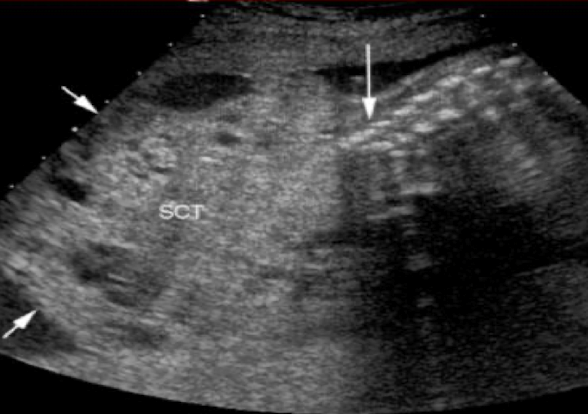 <p>sacrococcygeal teratoma </p>