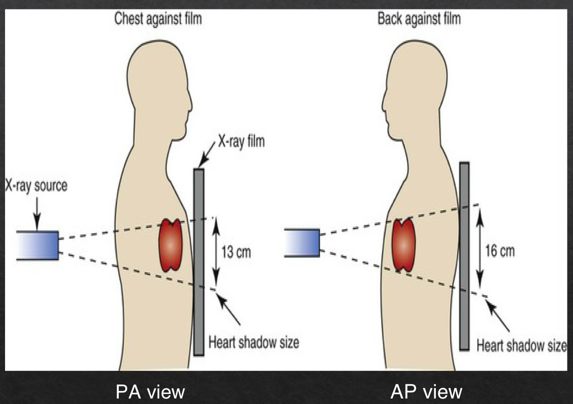 <ul><li><p>plays a role in assessing heart size</p></li><li><p>closer an object is to the surface on which it is being imaged, the more true to actual size the resultant object will be</p><ul><li><p>PA view is more true to size</p></li></ul></li><li><p>farther away → more magnified </p><ul><li><p>AP view </p></li></ul></li></ul><p></p>