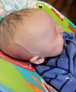 <ol><li><p><span style="color: rgb(92, 193, 40);"><strong>bulging fontanel</strong></span></p></li><li><p><span style="color: rgb(66, 177, 213);"><span data-name="arrow_up" data-type="emoji">⬆</span><strong>head circumference</strong>!</span></p></li><li><p><span style="color: rgb(115, 97, 219);">high pitched <strong>cry</strong></span></p></li><li><p><span style="color: rgb(218, 66, 235);"><strong>distended scalp veins</strong></span></p></li></ol><p></p>