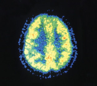 <p>Positron Emission Tomography (PET)</p>