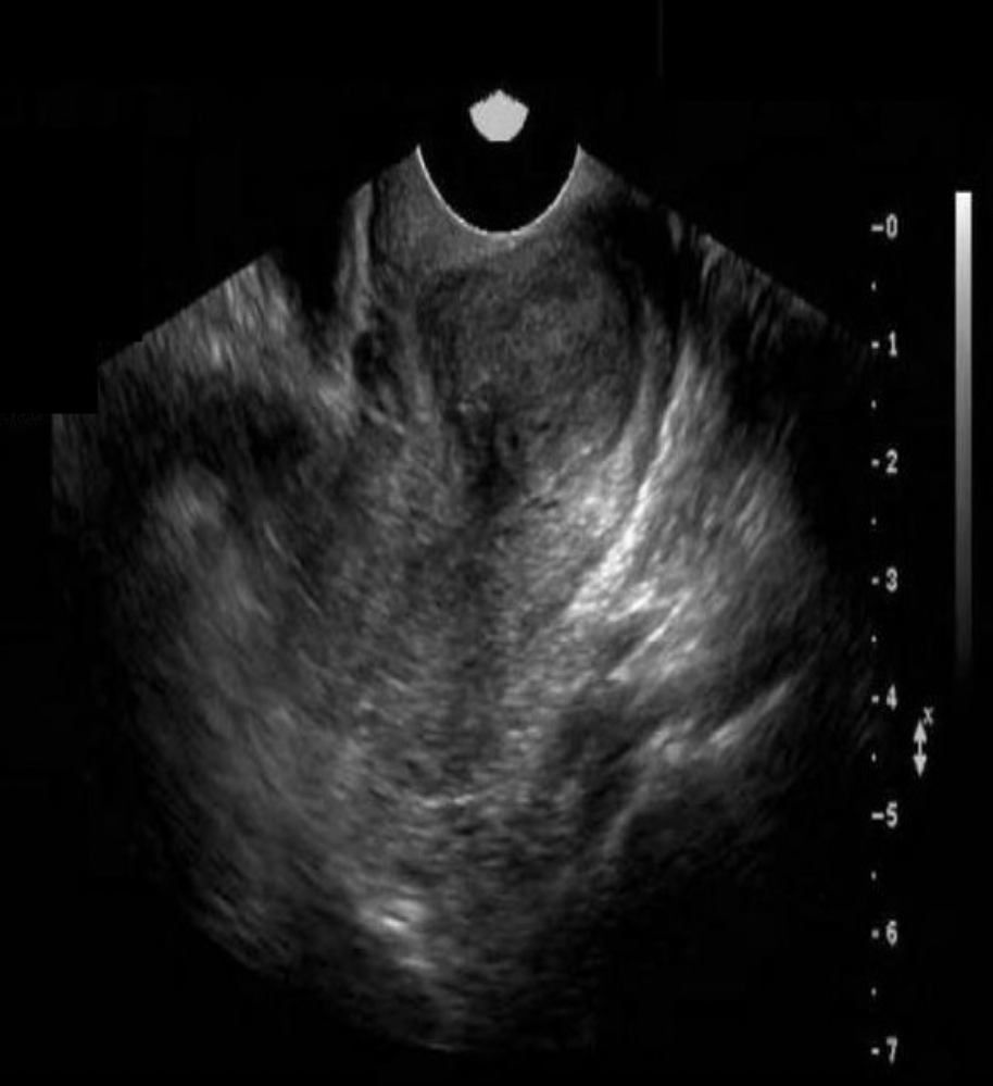 <p>A 30yr old patient presents with pelvic pressure and dyspareunia for a pelvic ultrasound. She had a partial hysterectomy 1 yr ago. Which of the following statements best describes the findings displayed?</p><p>A. There is a solid mass in the cervix, most likely carcinoma.</p><p class="p1">B. A large complicated nabothian cyst is present.</p><p class="p1">C. There is a large chronic hematoma remaining in the cervix.</p><p class="p1">D. There has been fibroid formation within the remaining uterine tissue left behind unintentionally.</p>