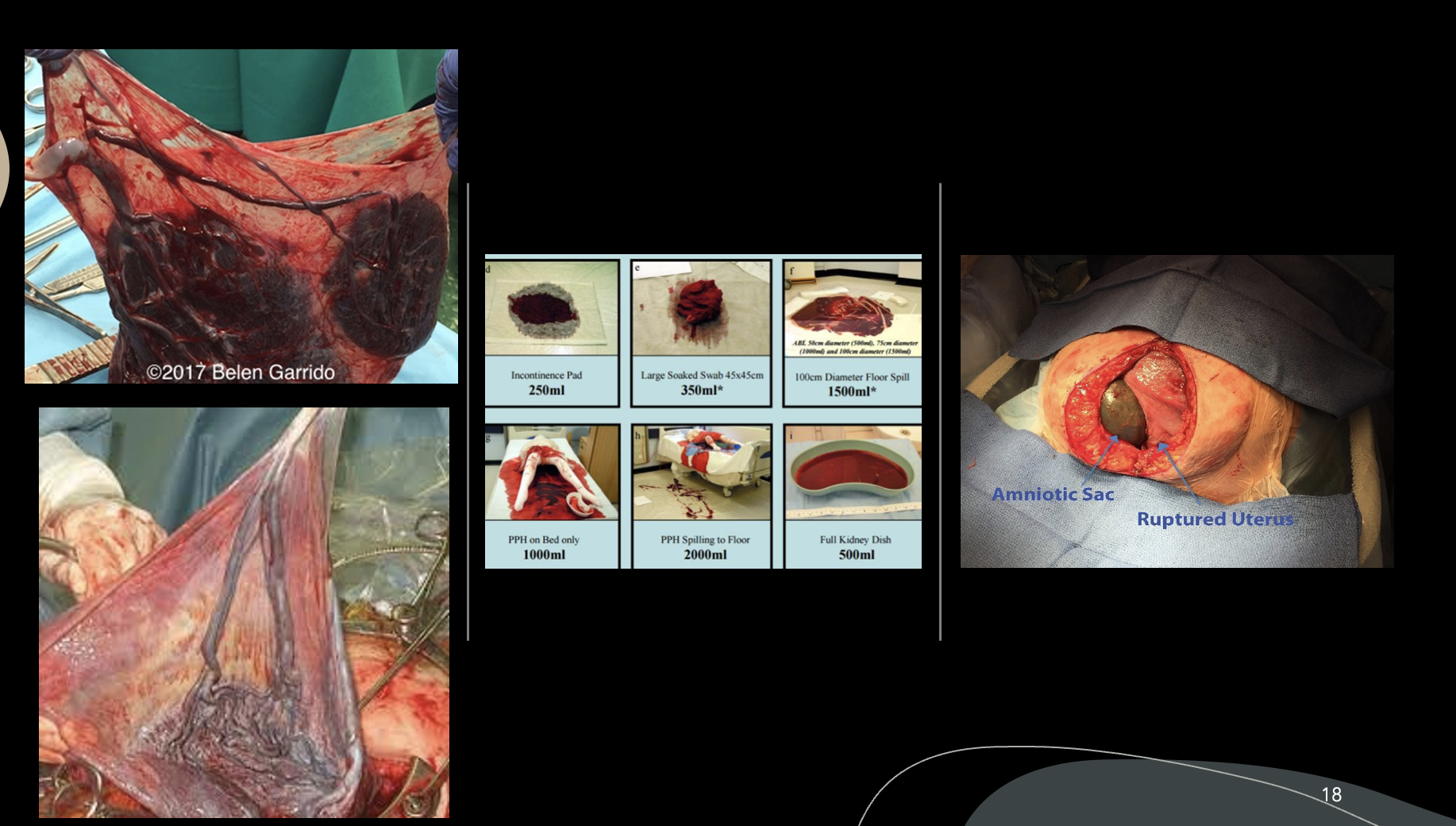 <p>Type 1- Vasa previa with velamentous cord insertion. </p><p>Type 2- Vasa previa with vessels connecting lobes of a bilobed or succenturiate placenta. </p><p></p>