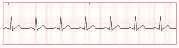 <p>Identify the heart rhythm on ECG strip</p>