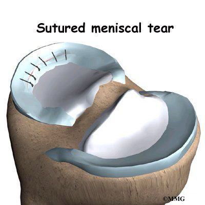<p>The edges of the tear are approximated and either sutured or tacked down<br>(sutures are more common d/t tacks sometimes falling out)</p>