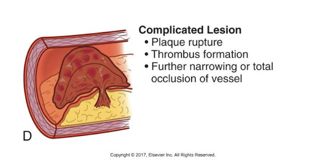 <p>dangerous stage</p><p>development of a complicated lesion </p><p>platelets aggregate and create a thrombus </p><p>high risk for MI  </p>