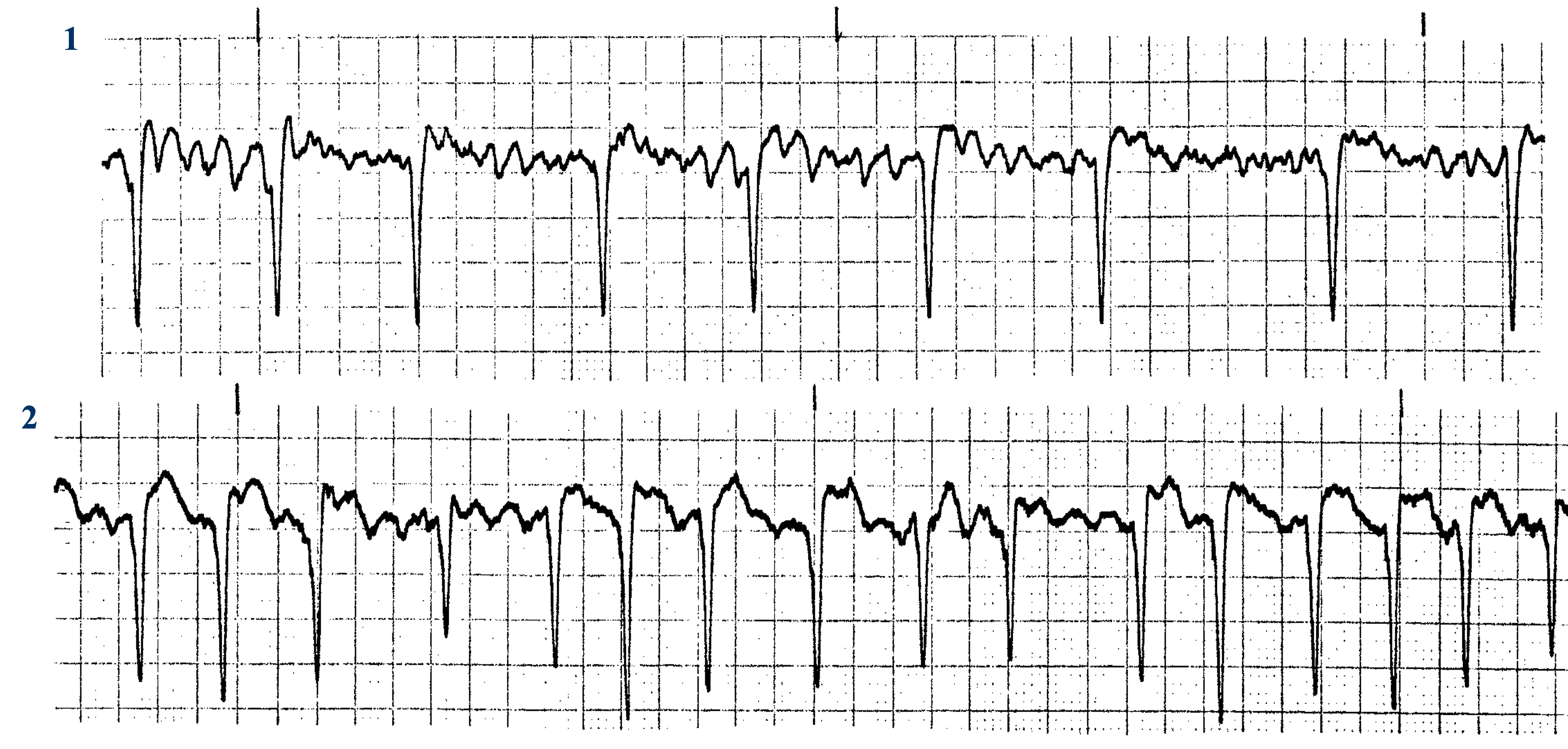 <p>What are these two ECGs? </p>
