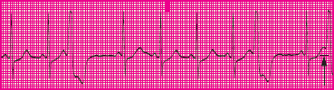 <p>Which rhythm is this?</p>