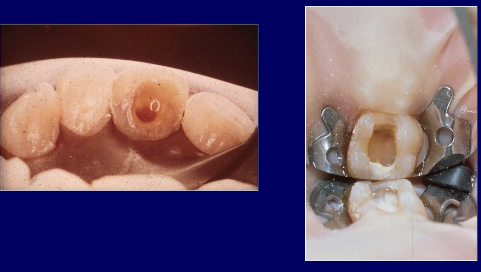 <ul><li><p>incision and drainage: allow tooth to drain until it stops- drainage through tooth may not occur </p></li><li><p>canal debridement: complete cleaning and shaping od the root canal system is preferred </p></li><li><p>NaOCl, Ca(OH)<sub>2</sub></p></li><li><p>analgesics for mild-moderate pain </p></li></ul><p></p>
