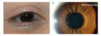 <p>What is the most likely diagnosis ?</p>