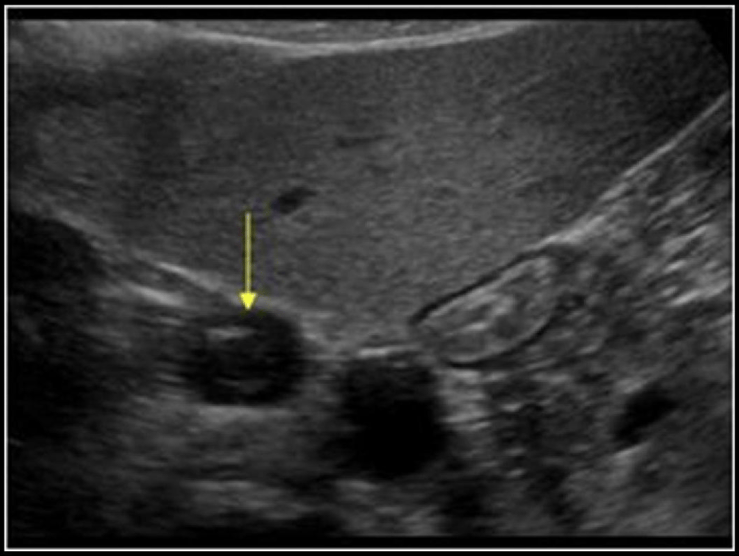 <p>IVC thrombosis</p>