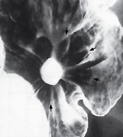 <p>Group of inflammatory processes involving the stomach and duodenum.</p>