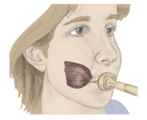 <p><span style="line-height: 107%;"><strong>Contracts cheeks to narrow mouth; </strong>directs bolus inside mouth; engages when blowing air out of narrowed mouth (e.g., balloon)</span></p>