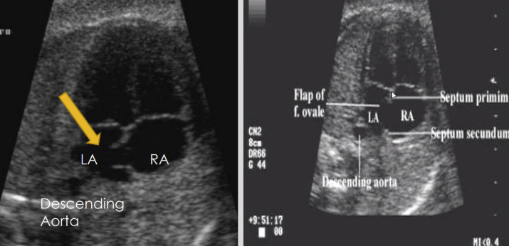 <ul><li><p><span style="background-color: transparent;">Normal atrial septum opening allowing blood to flow from RA to LA in utero</span></p><ul><li><p><span style="background-color: transparent;">Septum primum</span></p></li><li><p><span style="background-color: transparent;">Septum secundum</span></p></li></ul></li><li><p><span style="background-color: transparent;">~40% of fetal blood flows through FO&nbsp;</span></p></li><li><p><span style="background-color: transparent;">Seals within 24 hours after birth</span></p><ul><li><p><span style="background-color: transparent;">Closes due to&nbsp;</span></p><ul><li><p><span style="background-color: transparent;">Decreased RT heart pressure and PVR (pulmonary vascular resistance)</span></p></li><li><p><span style="background-color: transparent;">Increased LA pressure</span></p></li></ul></li></ul></li></ul><p></p>