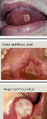 <p>Large, uncommon aphthae (Sutton disease), 1-10 lesions present uncommon!</p>