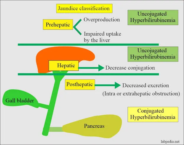 <ol><li><p><strong>Pre Hepatic Jaudice: Haemolysis</strong></p><ul><li><p>Excessive breakdown of red blood cells (haemolysis) produces more bilirubin than the liver can process.</p></li></ul></li><li><p><strong>Hepatic Jaundice: Liver Damage</strong></p><ul><li><p>Disease or damage of hepatocytes reduces the liver's ability to take up, conjugate, or secrete bilirubin into bile.</p><ul><li><p>Resulting in a build-up of unconjugated bilirubin.</p></li></ul></li></ul></li><li><p><strong>Post-hepatic Jaundice: Billary System Obstruction</strong></p></li></ol><ul><li><p>Cause by reduced bile flow/obstruction of bile excretion</p><ul><li><p>Conjugated bilirubin is unable excreted via the bile duct</p><ul><li><p>As a result it is released directly into the bloodstream</p></li></ul></li></ul></li></ul><p></p>