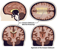 <p>What happens to the cingulate gyrus in callosal agenesis?</p>