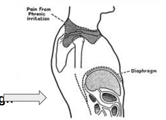 <p>Parietal pain at the diaphragm relayed through the phrenic nerve - Kehr’s sign</p>