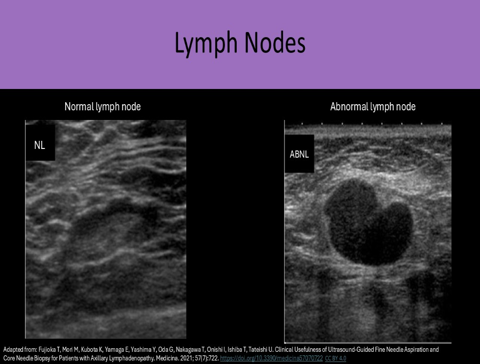 <p>C. thin hypochoic rim with hyperechoic central hilum</p><p>Normal lymph nodes are ovoid in shape. They do not demonstrate posterior enhancement. As lymph nodes enlarge with abnormal fluid accumulation, they appear more rounded and hypochoic/anechoic. The "plump" cortex causes decreased visualization of the central hilum. Color Doppler can be used to locate the hilum and main vascular supply. Posterior enhancement is present in structures posterior to abnormal nodes with significant fluid accumulation.</p>