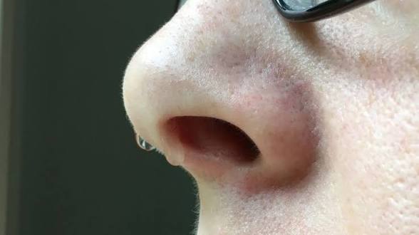 <p>Flujo o emisión abundante de líquido claro y mucoso a través de la nariz. </p>