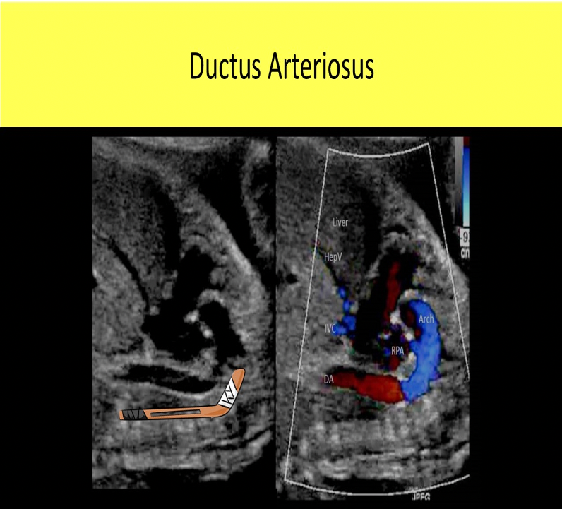 <p>C. ductus arteriosus</p><p>The ductus arteriosus is described as having a hockey stick appearance on sagittal views of the chest. The aortic arch is described as having a candy cane appearance in sagittal views. The ductus venosus in located in the abdomen.</p>