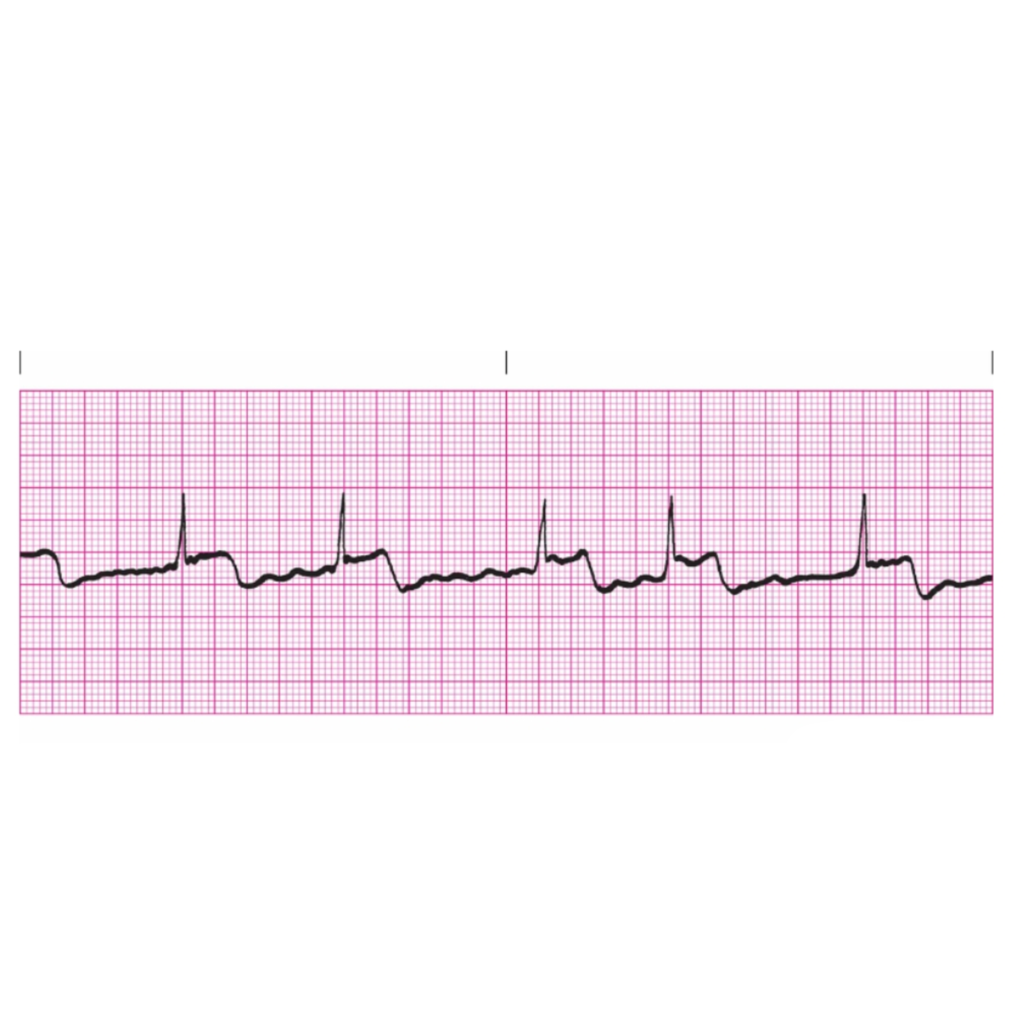 <p>Rules for Atrial Fibrillation includes</p>