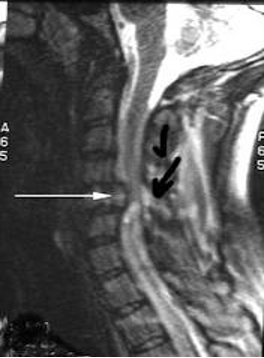 <ul><li><p>Asymmetrical flaccid paralysis below injury level</p></li><li><p>Asymmetrical loss of reflexes</p></li><li><p>Some sensory retention; feeling of pain, temperature, pressure, and touch</p></li><li><p>Some somatic and visceral sensation</p></li><li><p>More stable blood pressure</p></li><li><p>Ability to perspire intact unilaterally</p></li></ul><p></p>