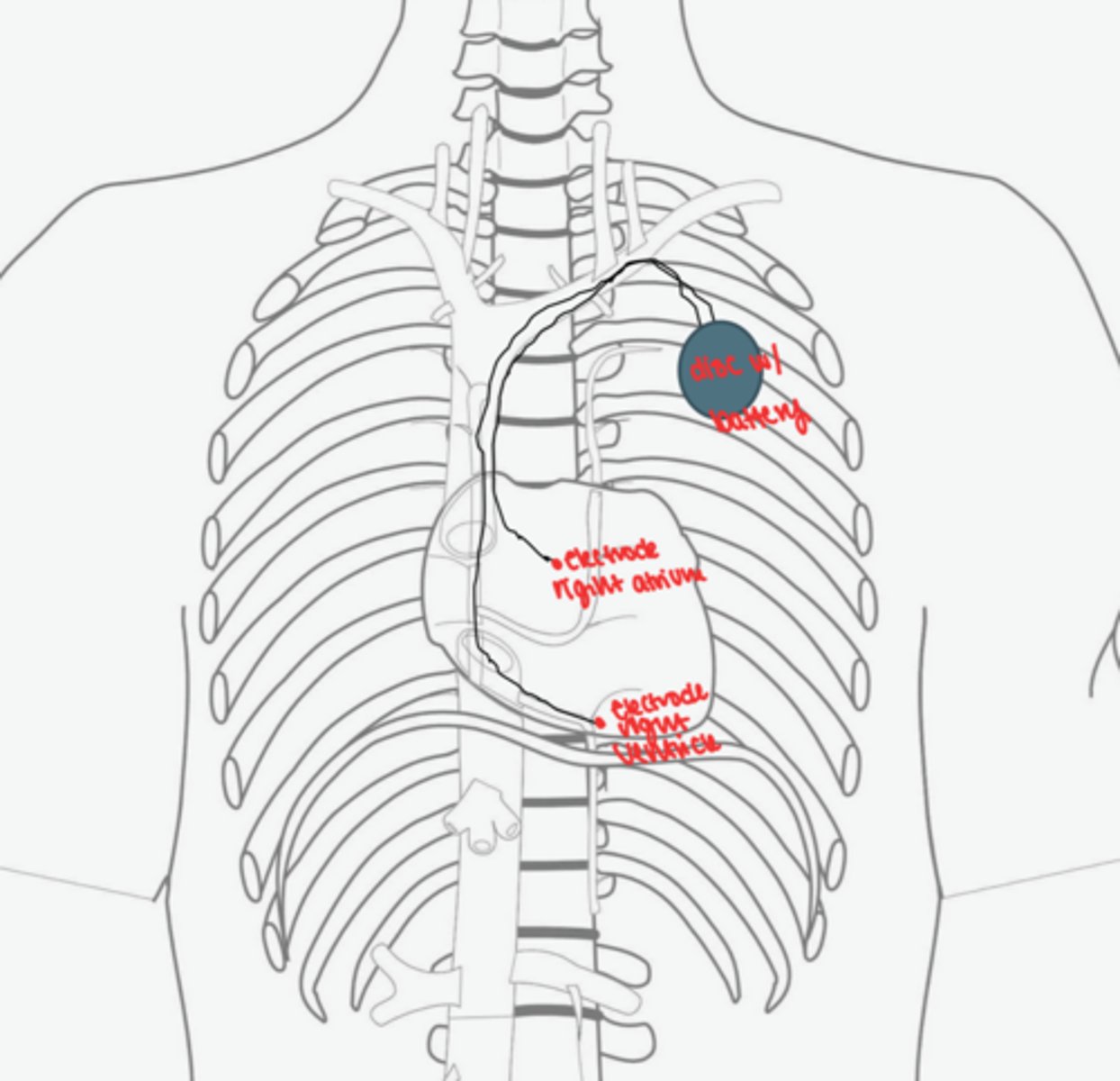 <p>subclavian vein -> SVC -> RA -> RV -> electrode wedged agains RV wall</p>
