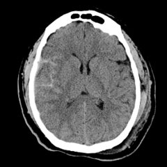 <p>trauma to small capillaries and veins, generally seen in the sulci or close to the surface of the brain (cortex) near traumatic insult:</p><p>- direct extravasation of blood from an adjacent cerebral contusion</p><p>- arterial dissection</p><p>- direct damage to small veins or arteries</p><p>- sudden increase in intravascular pressures leading to rupture</p>