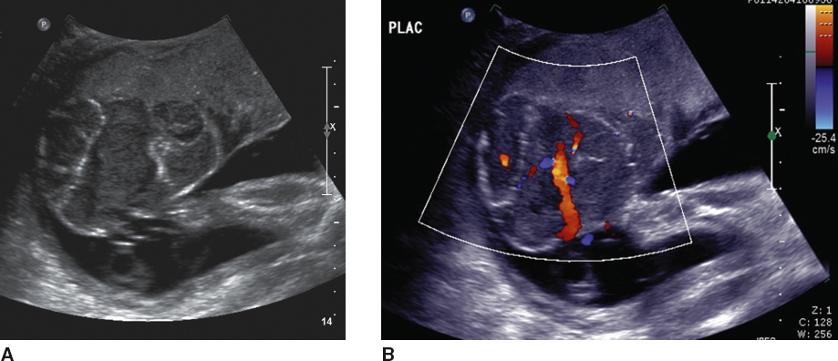 <p>Solid hypoechoic or hyperechoic mass within the placenta (common area is adjacent to chord insertion)</p>