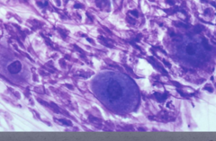 <p>Acantholysis -> desmoglein 1</p>