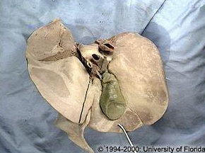 <p>what impression is being highlighted on the liver?</p>