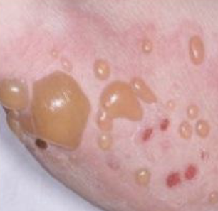 <p>a circumscribed, elevated lesion >5mm in diameter, usually contains serous fluid, looks like a blister</p>