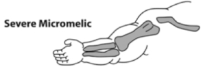 <p>shortening of <span style="color: yellow;">entire</span> limb</p>
