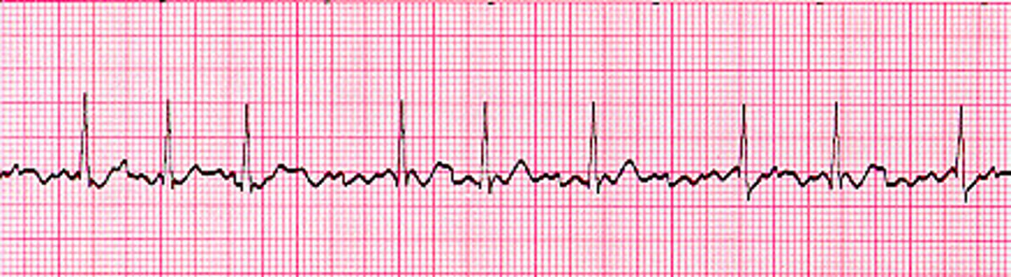 <p>how did you know this was a fib</p>