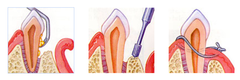 <p>For crown lengthening.</p><p>(Explanation: Osseous surgery exposes more tooth structure for restorations by reshaping bone, ensuring adequate crown height and biologic width.)</p>