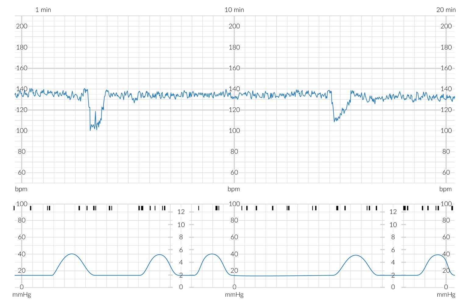 <p>What is the first-line treatment for <strong>variable decelerations (umbilical cord compression)</strong>?<br></p>