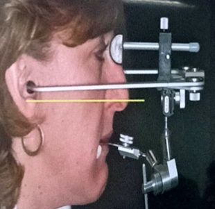 <p>fork is attached to the <span style="color: red;">maxillary occlusion rim</span></p><p>condyle rods placed approximately <span style="color: red;">over the condyles</span></p><p><span style="color: red;">widely used type</span> of facebow and are sufficient for fabrication</p><p>uses approximate <span style="color: red;">points on the face</span> as the posterior points and condylar rods are positioned on the points</p>