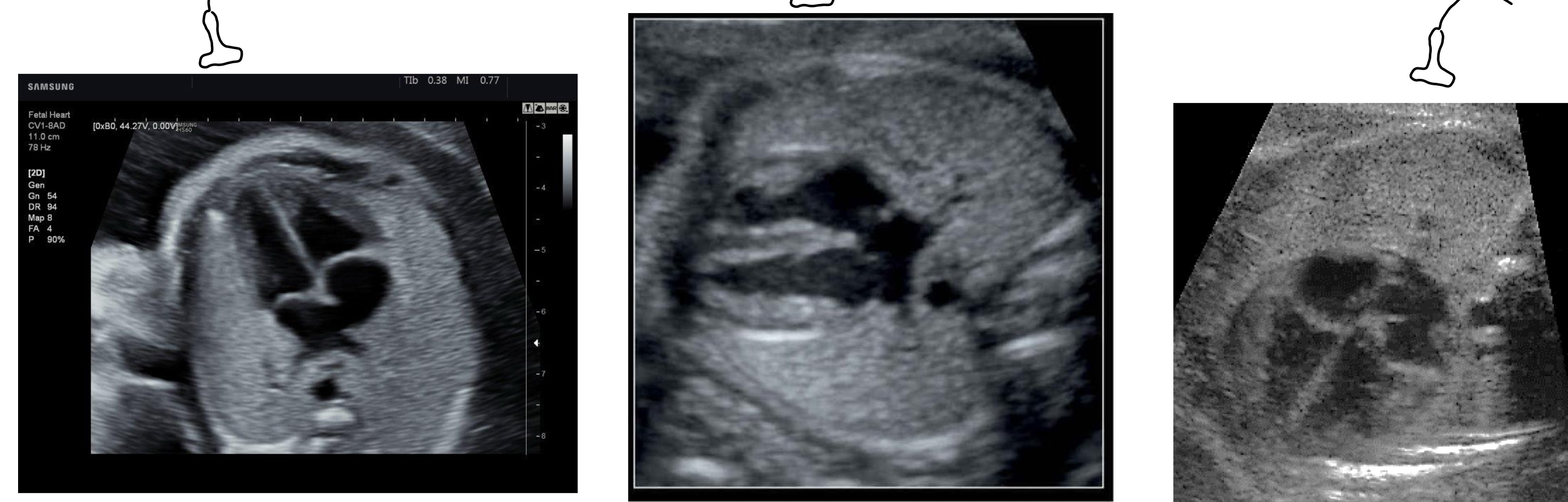 <p>What 4 chamber views are these from left to right?</p>