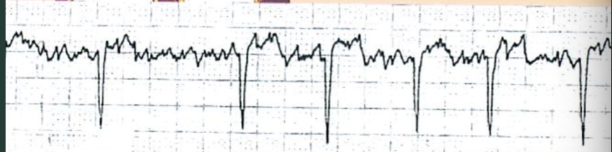 <p>Name the traits of Atrial fibrillation?</p>