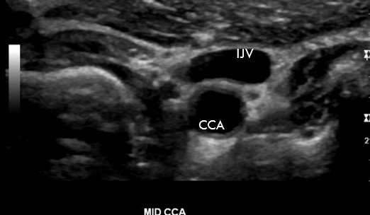 <p>True or False: This image shows a Trans CCA sonographic appearance</p>